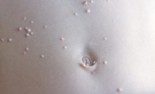 Molluscum contagiosum – an infectious viral skin disease
